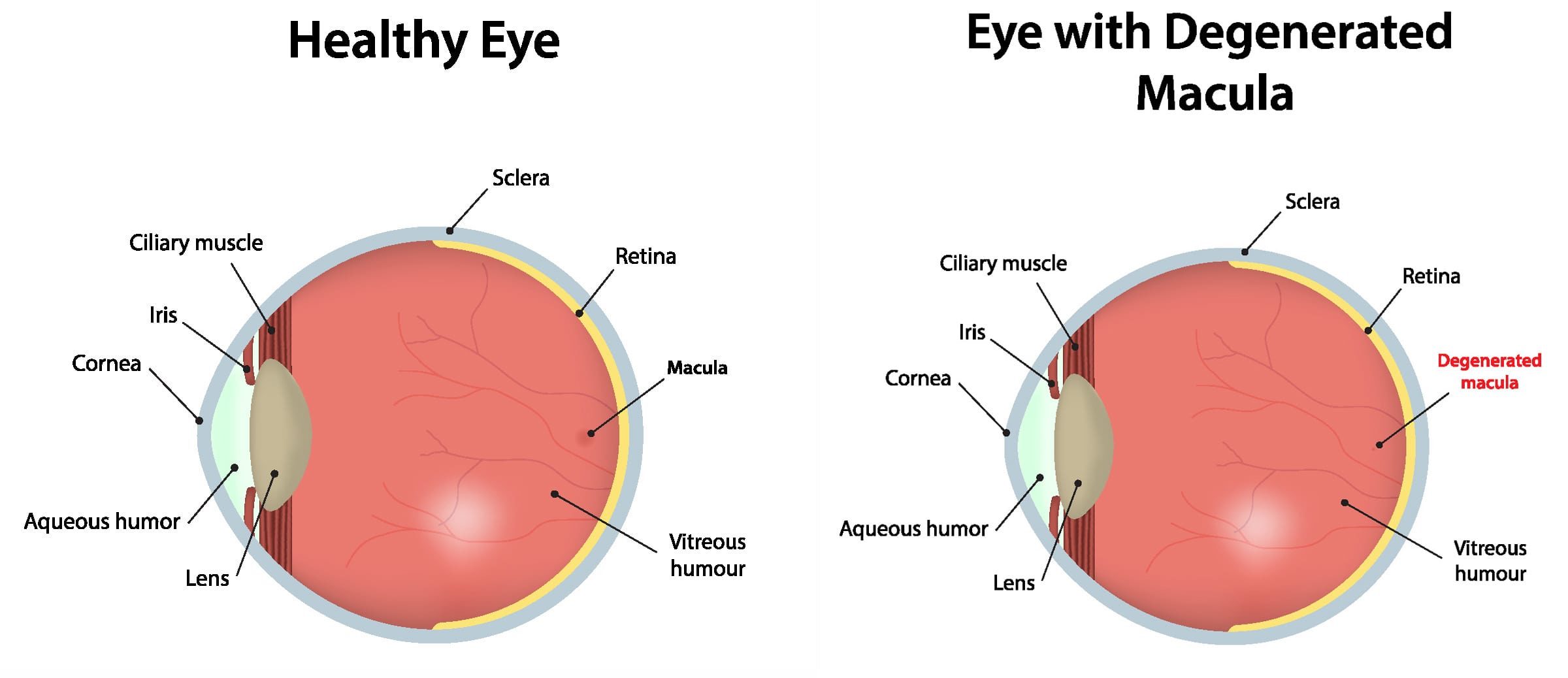 Age-related-Macular-Degeneration-6