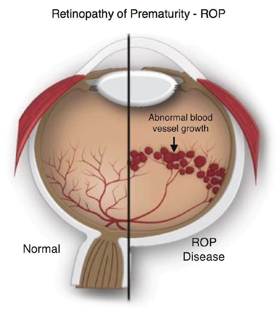 Retinopathy-of-Prematurity-ROP