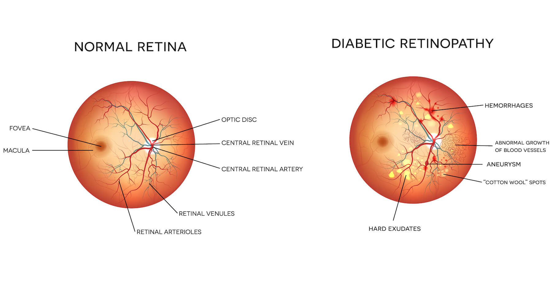 diabetic-retinopathy-vector